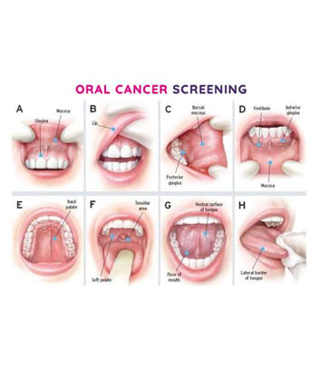 Oral Cancer Screening